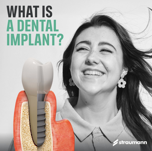 Dental Implants